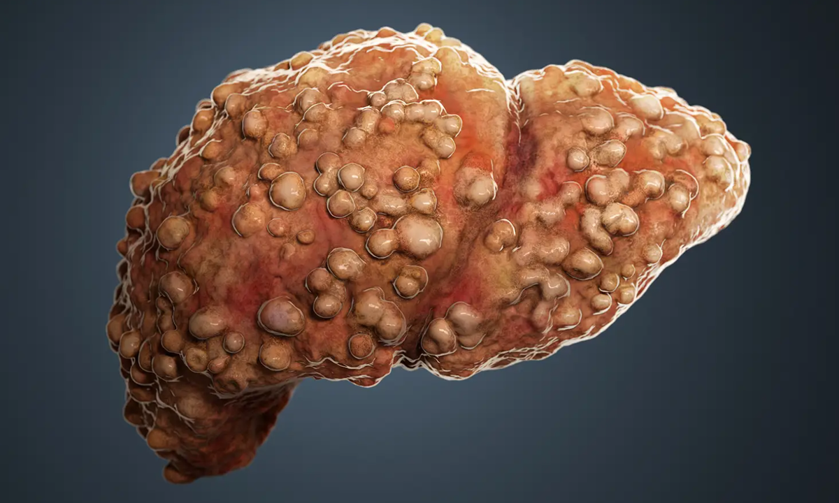 Низкий доход повышает риск цирроза печени